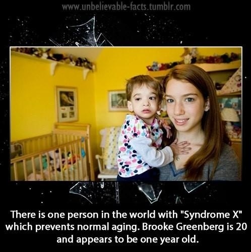 Did You Know That There Is One Person In The World With “Syndrome X”…